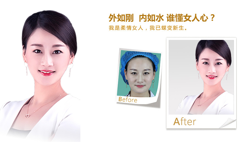 嘉兴V脸、线雕隆鼻